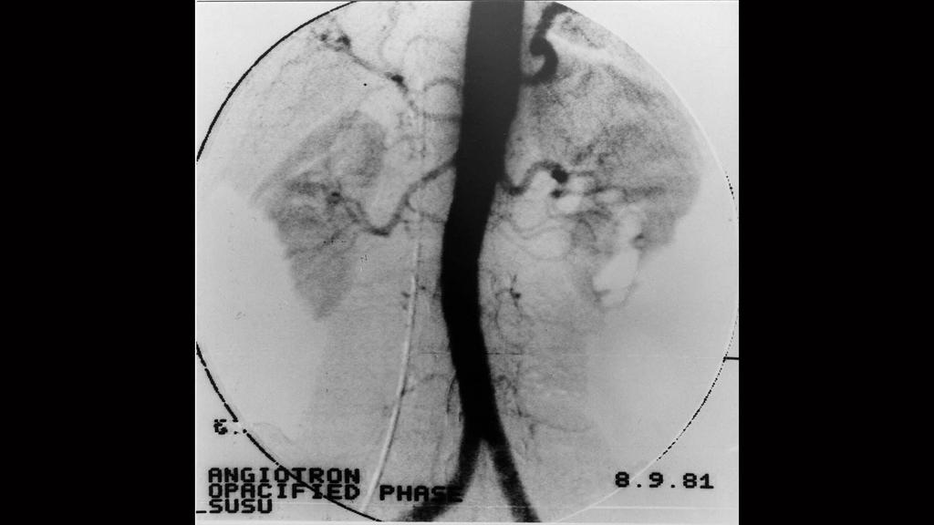 The history of interventional radiology