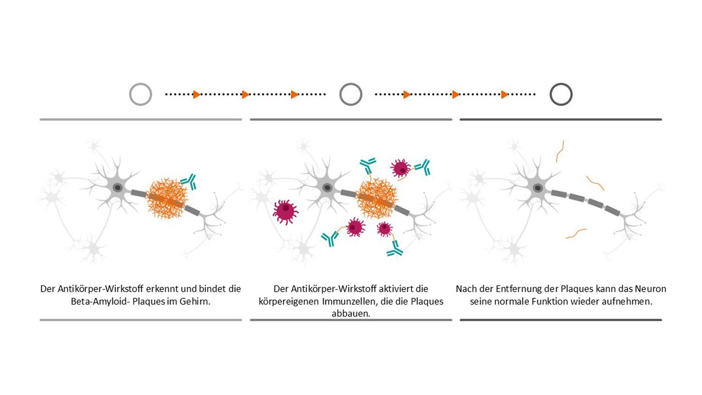 Siemens Healthineers Graphik Alzheimer Therapie