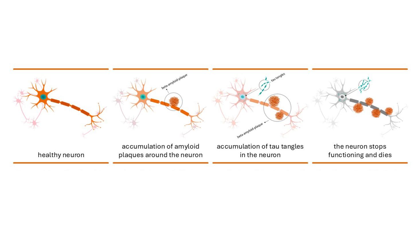 nerve cell with amyloid-plaques and tau fibrils