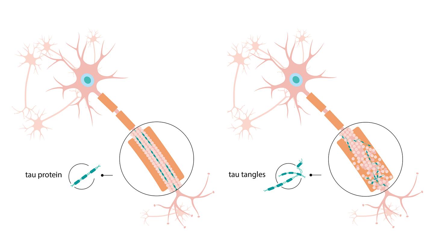 healthy nerve cell va. nerve cell with tau tangles