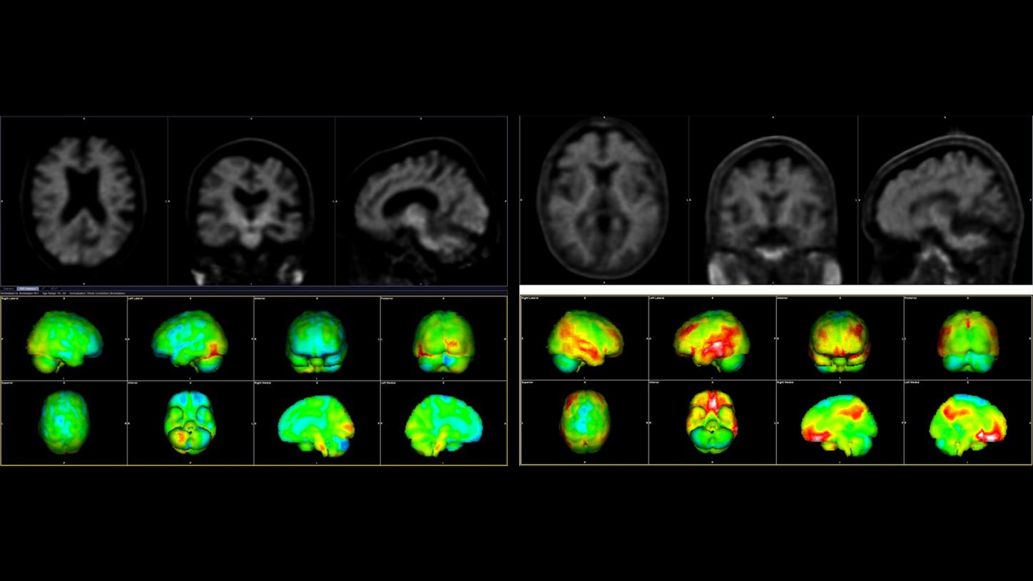 PET-CT Aufnahmen mit dem Tracer Amyvid