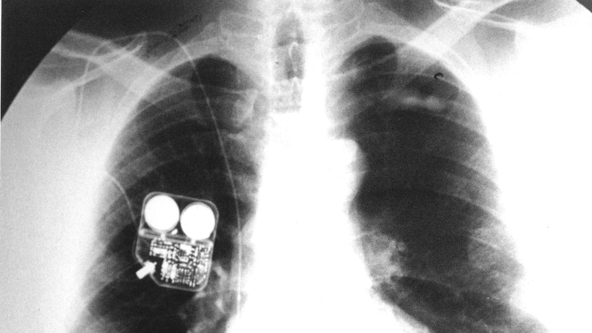 A Lifesaver in a Plastic Cup