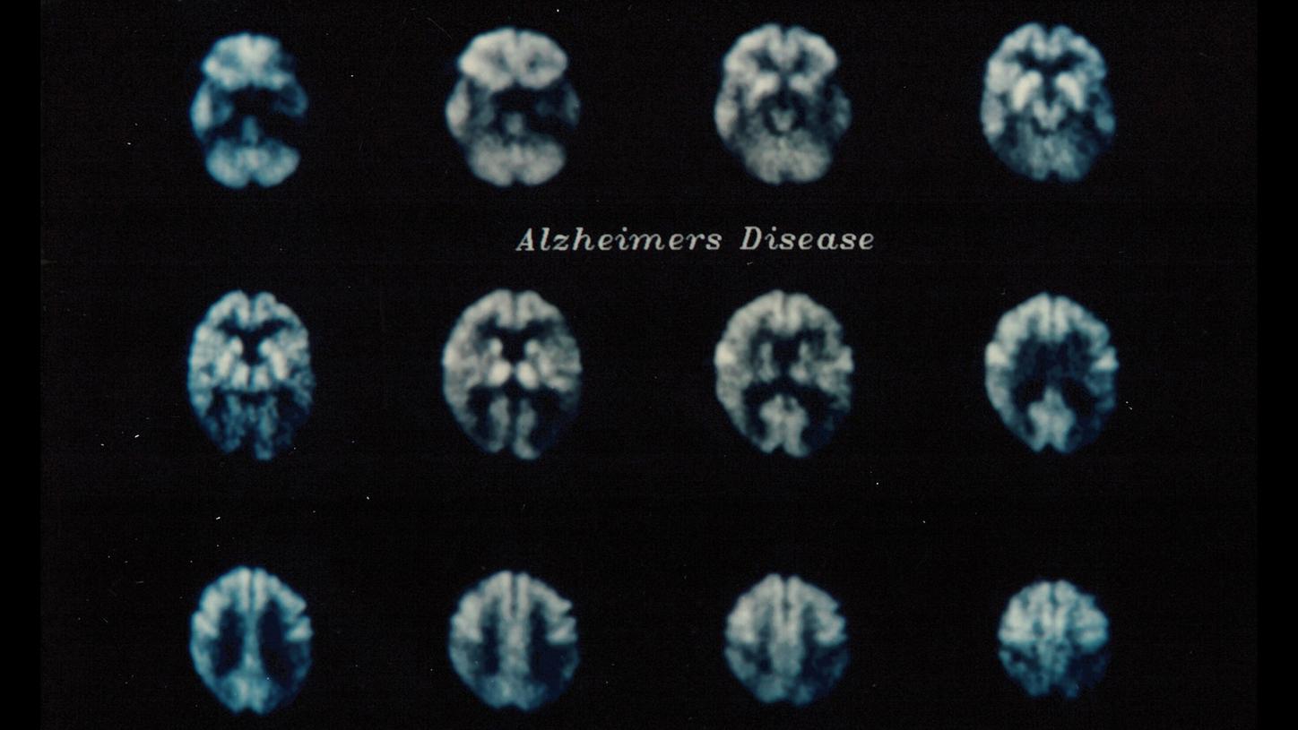 ECAT PET-Scan Alzheimer