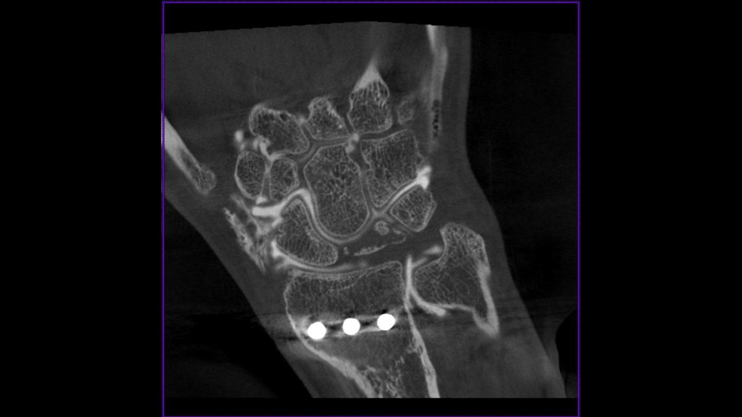 Abbildung eines triangulären fibrokartilaginären Komplexes am Handgelenk mit syngo DynaCT Micro, 2012.